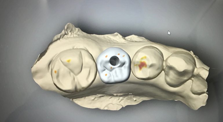 3Dプリンタを使用したインプラント治療
