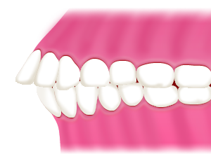 軽度の出っ歯は部分矯正で直りますが、重度の場合は全体矯正が必要になります。
