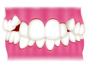 大阪のHANA Intelligence 歯科•矯正歯科では、叢生は部分矯正で治せる可能性があります。